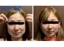 たかす整骨院/小顔/浮腫み/たるみ/ほうれい線