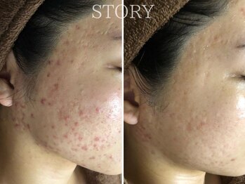 ストーリー 沼津店(STORY)/ハーブピーリング専門店STORY