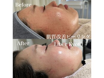 リベルキョウト 京都駅前店(Liber Kyoto)/肌質改善ピーリング