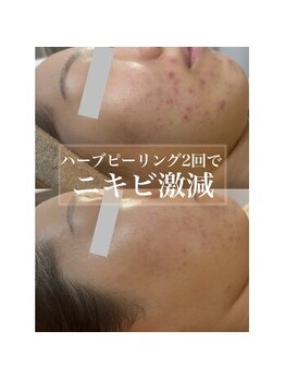 サロン ド ベル(Salon de Belle)/ニキビ改善にはREVI！