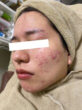 ノーブル 新宿南口(NOBLE)/新宿ハーブピーリングNOBLE