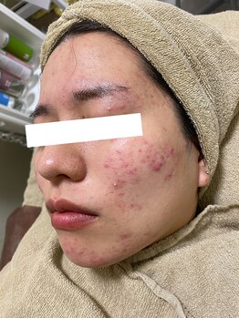 ノーブル 新宿南口(NOBLE)/新宿ハーブピーリングNOBLE