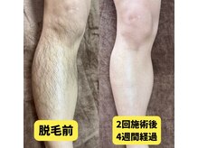 フェリス(FELIZ)/2回目施術後4週間経過