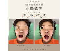 リボーンプラス タカハマ整骨院/【顎関節・小顔矯正】施術例