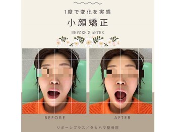 リボーンプラス タカハマ整骨院/【顎関節・小顔矯正】施術例