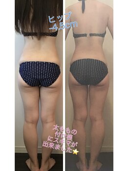 レナトゥス 銀座(Renatus)/before＆afterr【痩身/銀座】