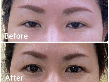 とだ鍼灸指圧治療院/当院No1メニューの美容鍼！