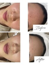 ビズビズ 梅田店(bisebise)/〈症例〉赤ら顔・ニキビケア