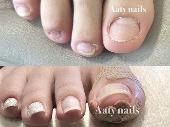 アーティネイルズ(Aaty Nails)の写真/【隠したかった足の深爪も見た目改善】今のうちに深爪や巻き爪改善して綺麗な足先でサンダルを◎