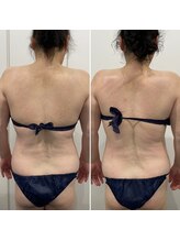 ベリッセ(Belisse)/腰回りをスッキリと！痩身エステ