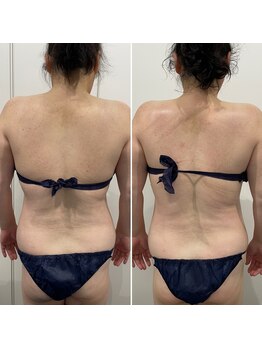 ベリッセ(Belisse)/腰回りをスッキリと！痩身エステ