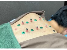 谷塚みんなの鍼灸整骨院/自律神経の乱れにはお灸が◎