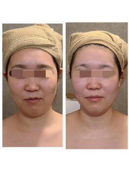 ウォーマル(warmaL)/小顔矯正/2回でこの変化！