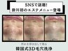 浮き出る毛穴洗浄（韓国式3D毛穴洗浄）¥ 15400→ ¥8800【2ヶ月以内再来】
