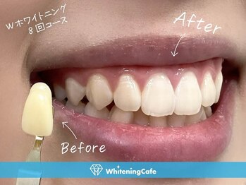 ホワイトニングカフェ 神戸元町店(WhiteningCafe)/◎歯のホワイトニング施術写真◎