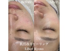 リベルキョウト 京都駅前店(Liber Kyoto)/肌質改善ピーリング