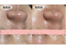ストーリー(STORY)/眉毛と艶肌ワックス専門店