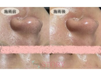 ストーリー(STORY)/眉毛と艶肌ワックス専門店