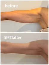 アンフィルミエール 新宿店(infirmiere)/二の腕引き締め