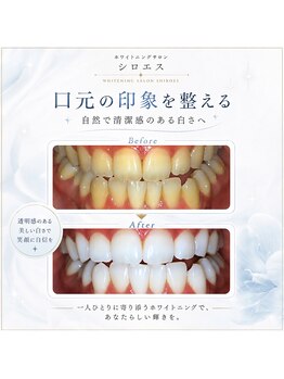 シロエス バイ アイヴィー 門前仲町(シロエス by EYEVY)の写真/結婚式は白い歯で♪初めてのセルフホワイトニングで歯に清潔感を整える特別なケアを♪