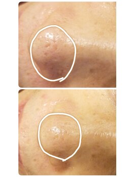 ヴィゴラス/本気の肌質改善ハーブピーリング