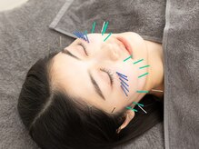 オプト鍼灸整体院 たまプラーザ本院(opt.鍼灸整体院)/美容鍼でしわ・たるみの改善
