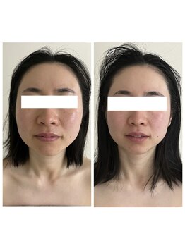 ルルボーテ(Loulou Beaute)/頭蓋骨調整+小顔矯正