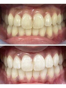 ブリリアント(Brilliant)/美容ホワイトニング　