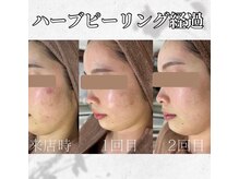 ホワイトアクア 中目黒店(WHITE AQUA)/ハーブピーリング/ニキビ/中目黒