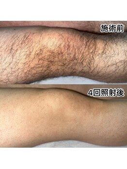 フルール(fleur)/男性[全身脱毛]VIO込