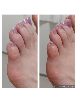 遊歩堂/小指上魚の目