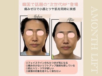 ミリュール(Millule)/アマンスでエイジングケア