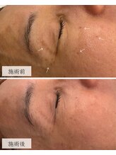 ラシック(La Chic)/シミケア6回