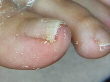 爪切り屋 足楽/爪の痛み！？