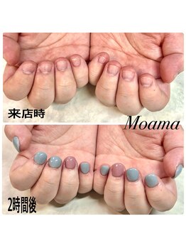 モアナ 池袋(MOANA)/人工爪深爪
