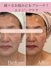 ココロ(COCORO)/眉間のしわ・ほうれい線も♪