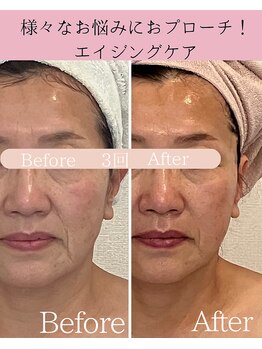 ココロ(COCORO)/眉間のしわ・ほうれい線も♪