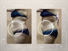 アバンダンティア 姫路店/キャビテーション×脂肪冷却