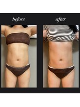 エヌボーテ(N. beaute)/お腹周り・くびれコース二回目