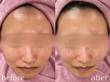 マシェリ(macherie)/リフトアップ効果もあるんです!