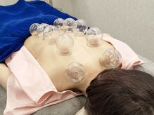 なか鍼灸マッサージ院/吸玉（すいだま）の施術