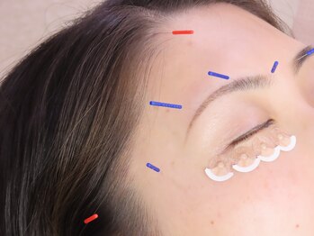 飯田橋駅前鍼灸整骨院/美容鍼【飯田橋/鍼灸】