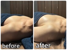 リルマコ/バスト症例写真