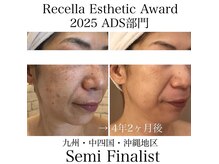 ビューティーサロン メイプルツリーの雰囲気（シミ改善はもちろん、肌質までも変わってリフトアップを実感♪）