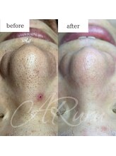 アルル(ARuru)/毛穴エクストラクション