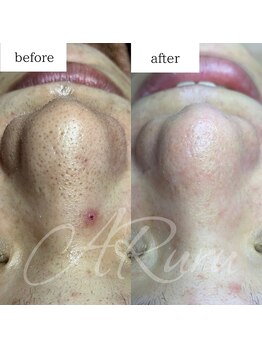 アルル(ARuru)/毛穴エクストラクション