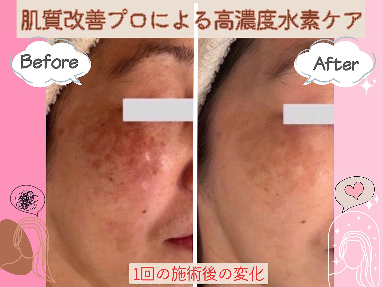 天王寺駅でダイヤモンドピーリングが人気のエステサロン