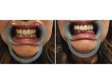 プルメリア(Plumeria)/セルフホワイトニング