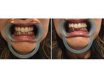 プルメリア(Plumeria)/セルフホワイトニング