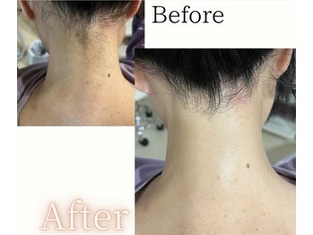 イーサム(e-sam)/襟足脱毛